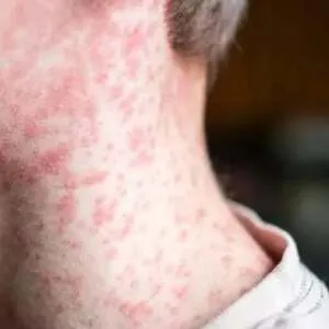 Кір в Кривому Розі: Як розпізнати, уберегтися та що робити при загрозі. Все, що потрібно знати про небезпечну хворобу.